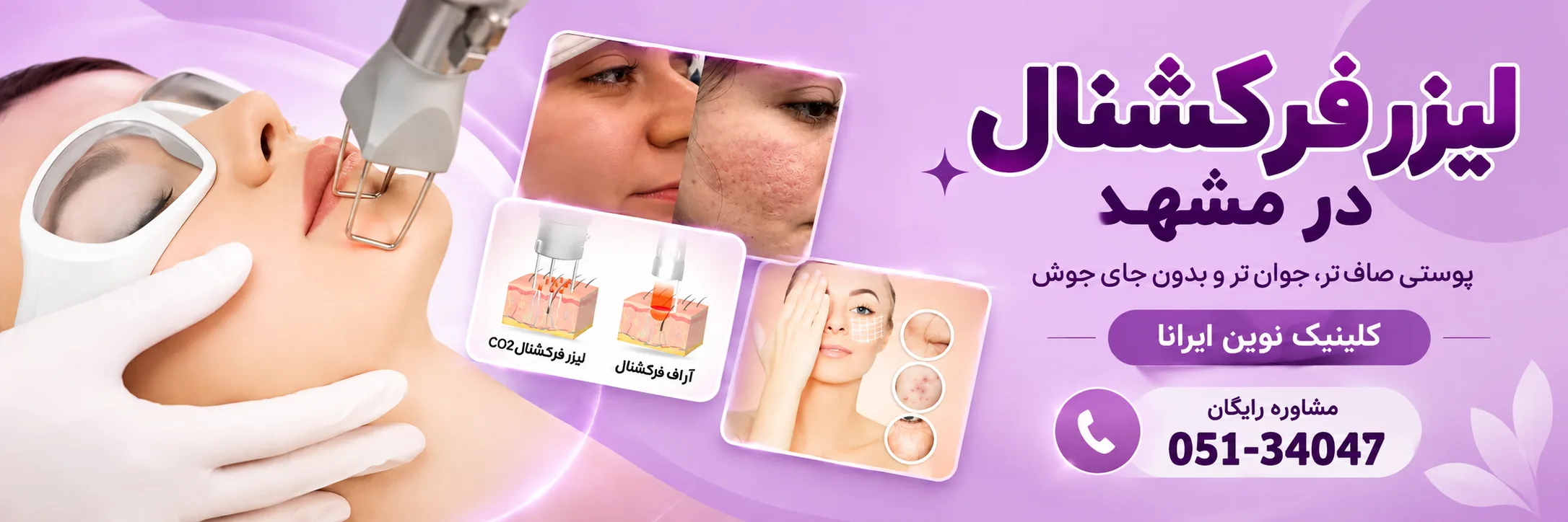 لیزر فرکشنال در کلینیک نوین ایرانا